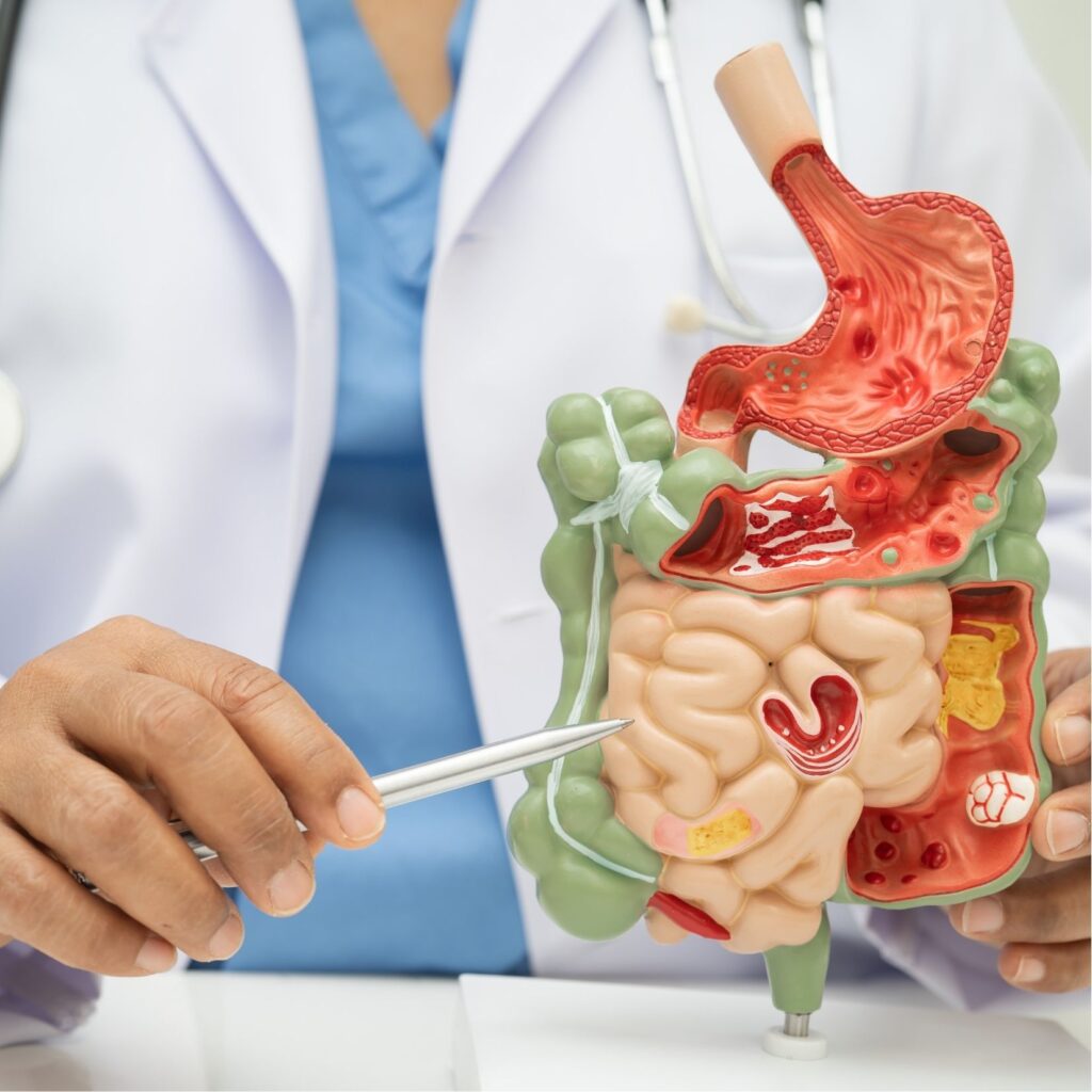 IBD גסטרואנטרולוגיה