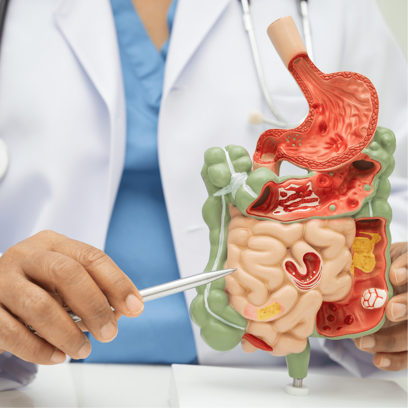 IBD גסטרואנטרולוגיה