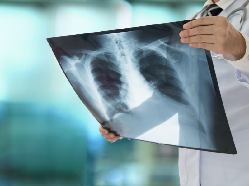 אבחון אוסטאופורוזיס